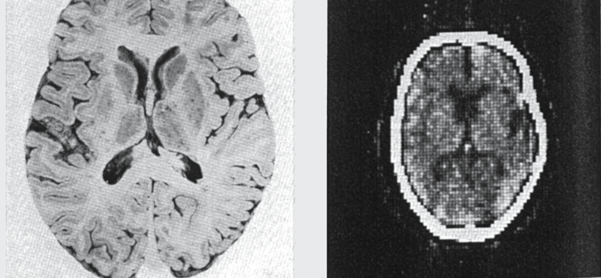 Jeden z pierwszych tomogramów mózgu.